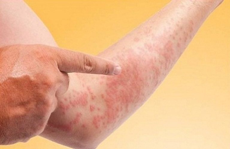 Tarvicort-N Tuýp 15g - Điều Trị Các Bệnh Ngoài Da