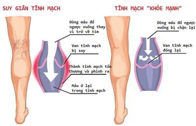 Hesmin Hộp 100 Viên - Điều Trị Suy Tĩnh Mạch