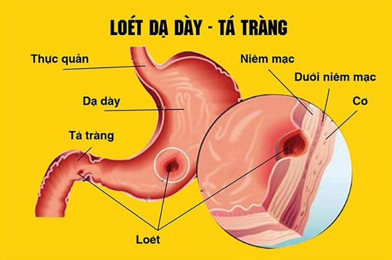 Moprazol Hộp 100 Viên - Điều Trị Loét Đường Tiêu Hóa
